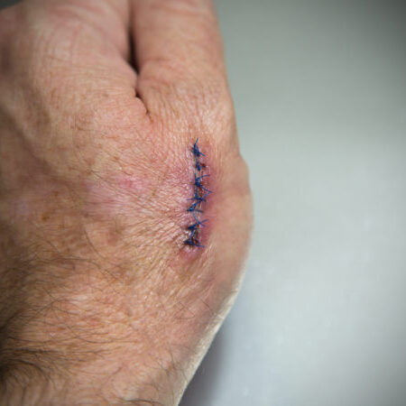 A hand with stitches.